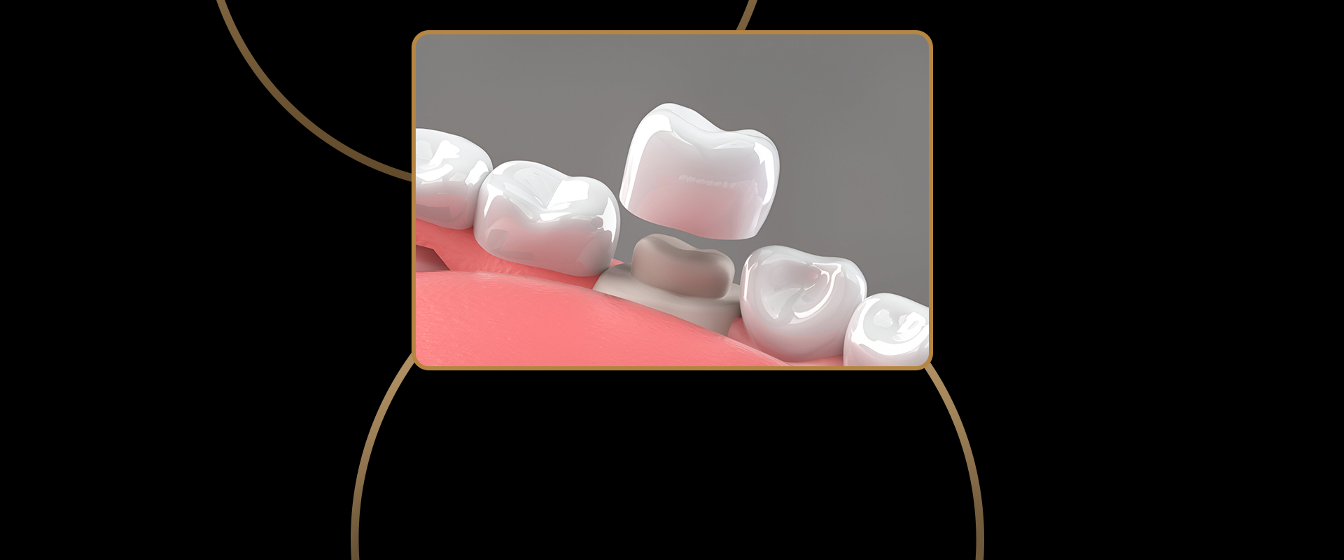 Dental Crowns & Bridges
